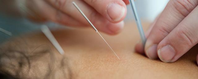 Akupunktur | 